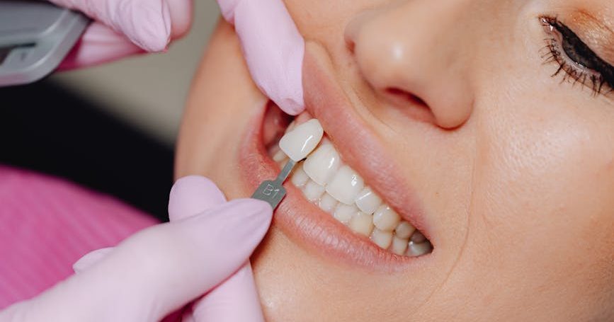 a dentist applying a veneer tooth on a patient